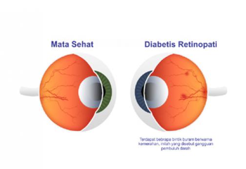   Retinopati Diabetik