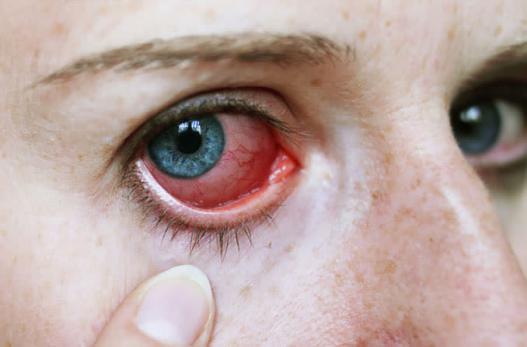 Uveitis